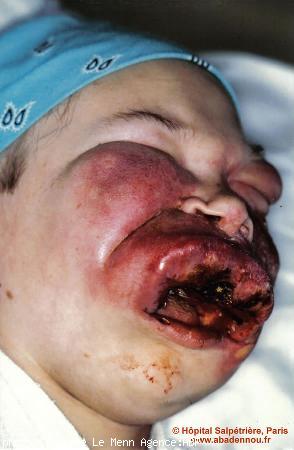 Coralie sur son lit d\'hôpital à Paris (La Salpétrière)