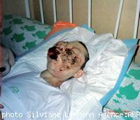 Coralie ostéosarcome maxillo-facial rare et incurable.