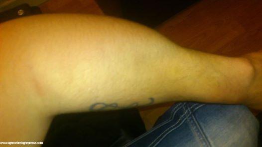 Bras enflé de Wolfgang Bourlett après sa capture par la police, le 15-02-14, à Brech (56)